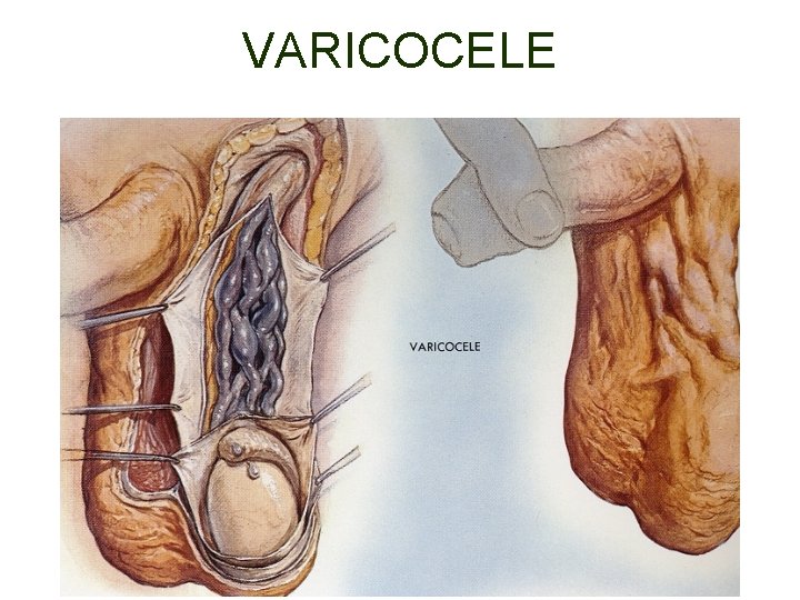 VARICOCELE 