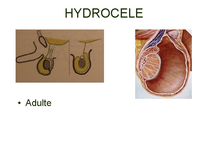 HYDROCELE • Adulte 