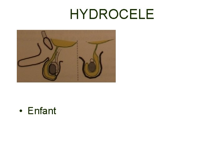 HYDROCELE • Enfant 
