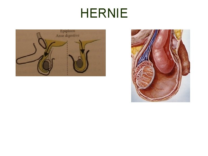 HERNIE 