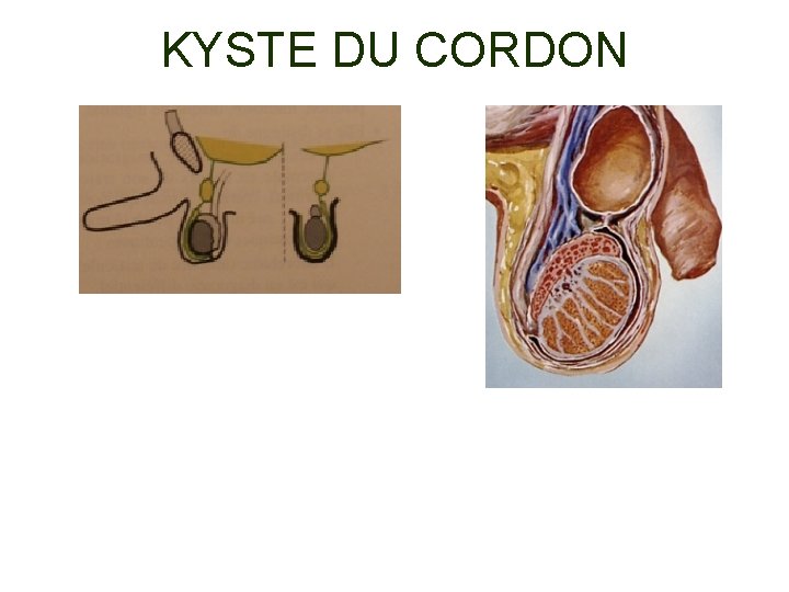 KYSTE DU CORDON 