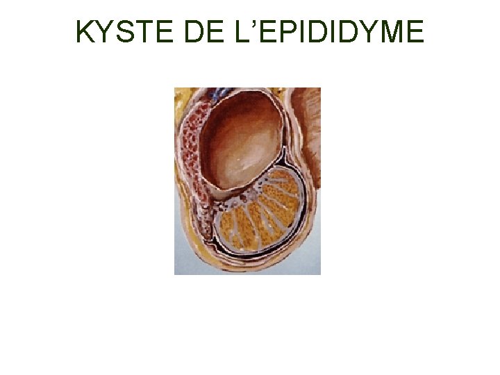 KYSTE DE L’EPIDIDYME 
