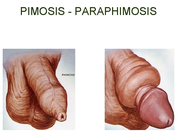 PIMOSIS - PARAPHIMOSIS 