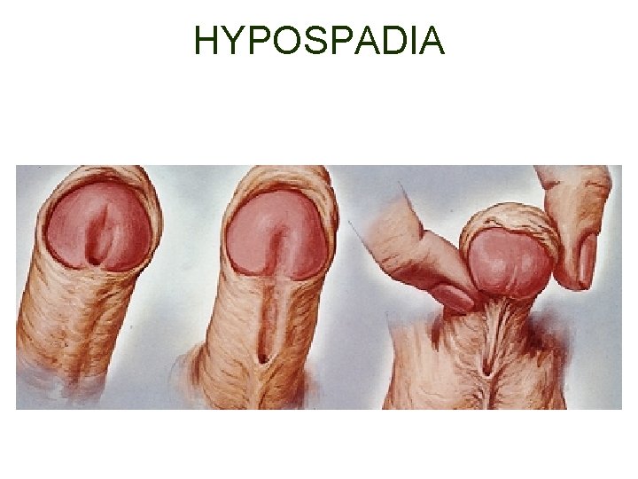 HYPOSPADIA 