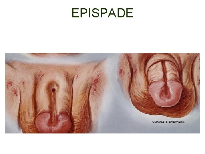 EPISPADE 