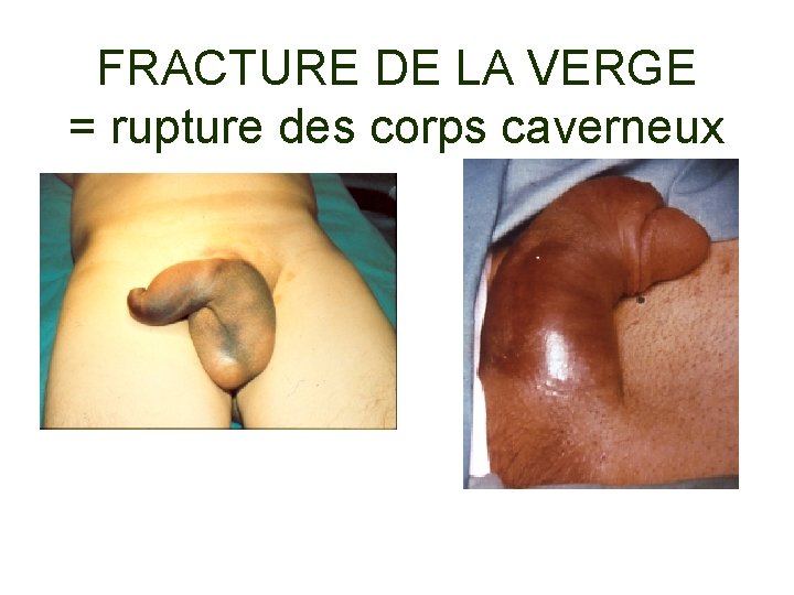 FRACTURE DE LA VERGE = rupture des corps caverneux 