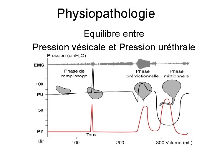Physiopathologie Equilibre entre Pression vésicale et Pression uréthrale 