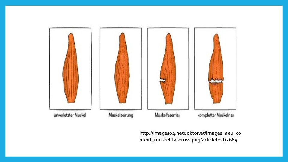 http: //images 04. netdoktor. at/images_neu_co ntent_muskel-faserriss. png/articletext/2669 