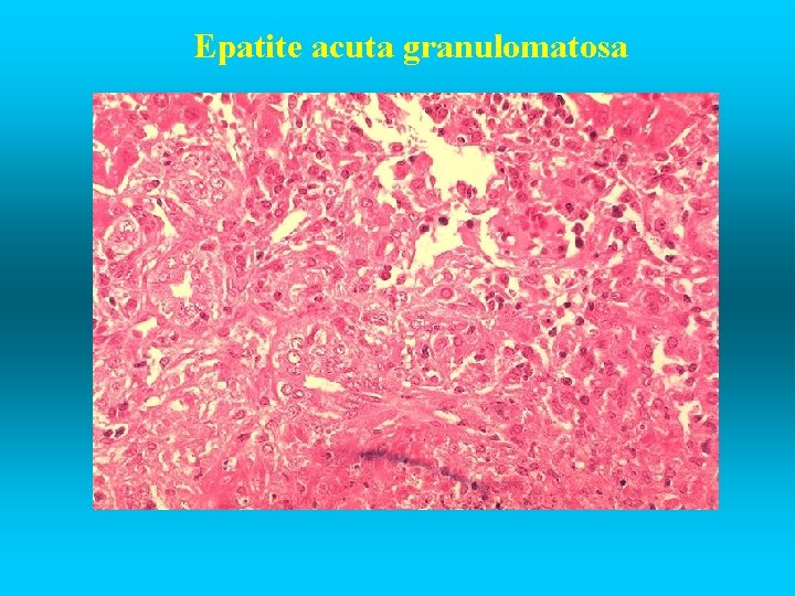 Epatite acuta granulomatosa 