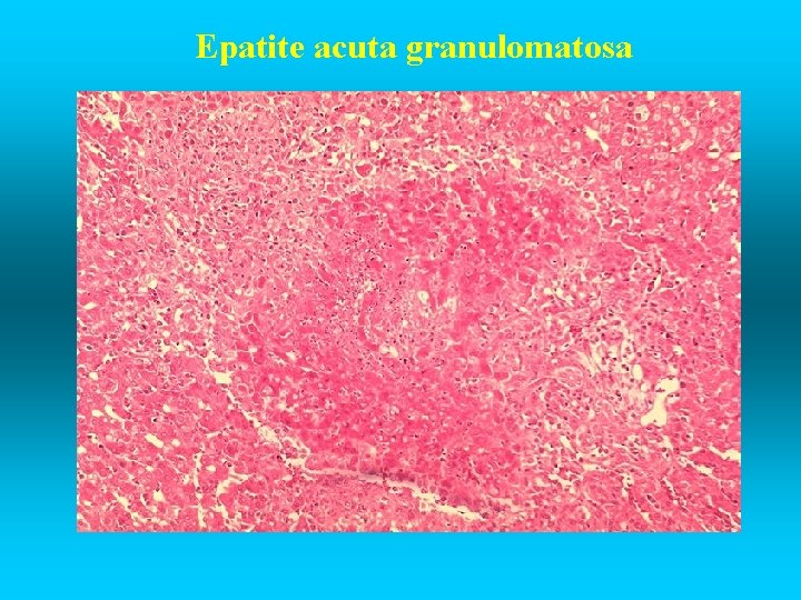 Epatite acuta granulomatosa 