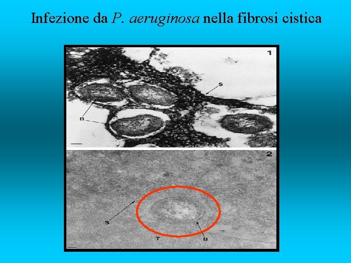 Infezione da P. aeruginosa nella fibrosi cistica 