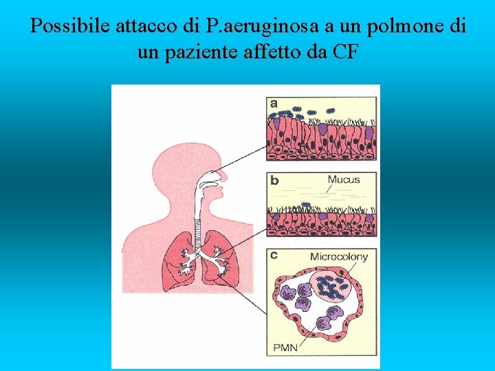 Possibile attacco di P. aeruginosa a un polmone di un paziente affetto da CF