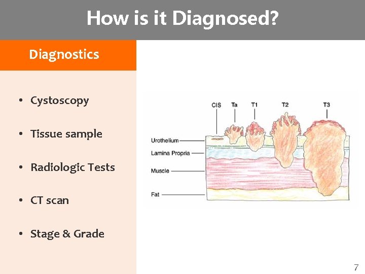 How is it Diagnosed? Diagnostics • Cystoscopy • Tissue sample • Radiologic Tests •