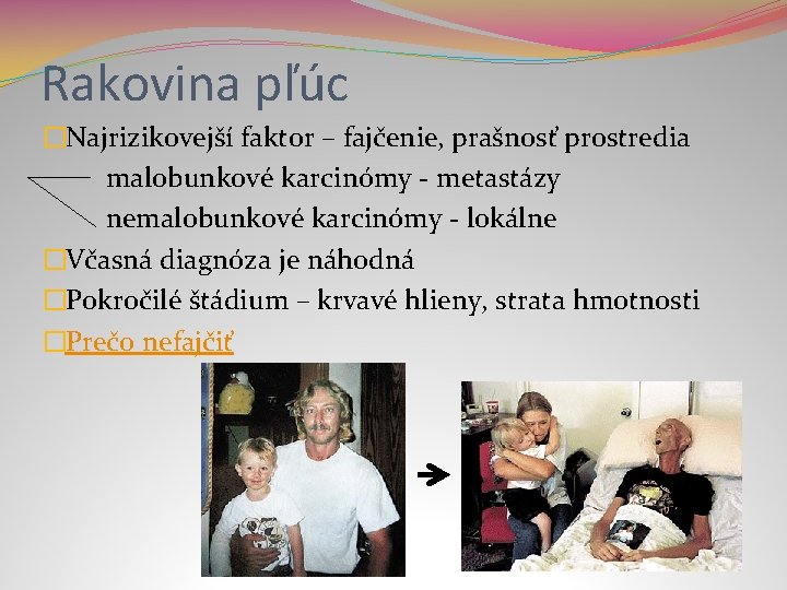 Rakovina pľúc �Najrizikovejší faktor – fajčenie, prašnosť prostredia malobunkové karcinómy - metastázy nemalobunkové karcinómy