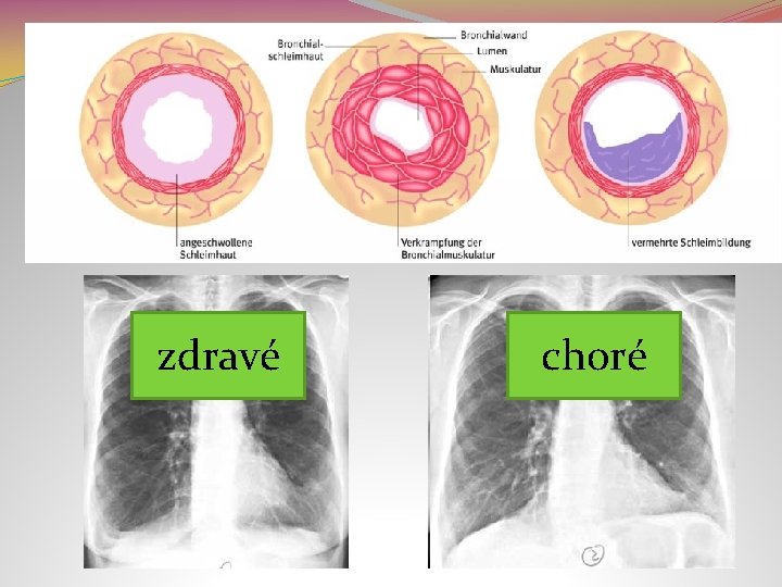 zdravé choré 