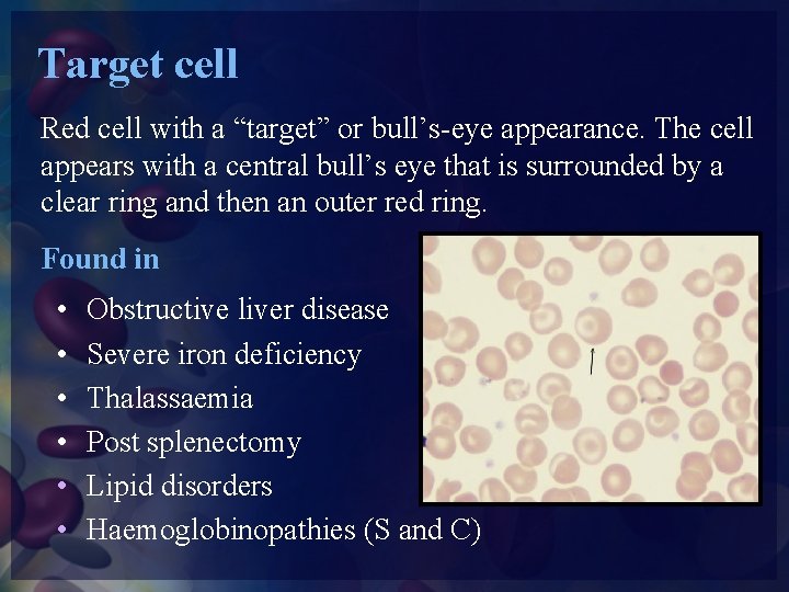 Target cell Red cell with a “target” or bull’s-eye appearance. The cell appears with