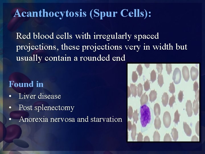 Acanthocytosis (Spur Cells): Red blood cells with irregularly spaced projections, these projections very in