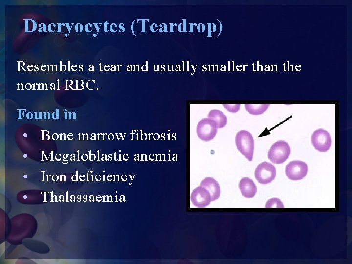 Dacryocytes (Teardrop) Resembles a tear and usually smaller than the normal RBC. Found in