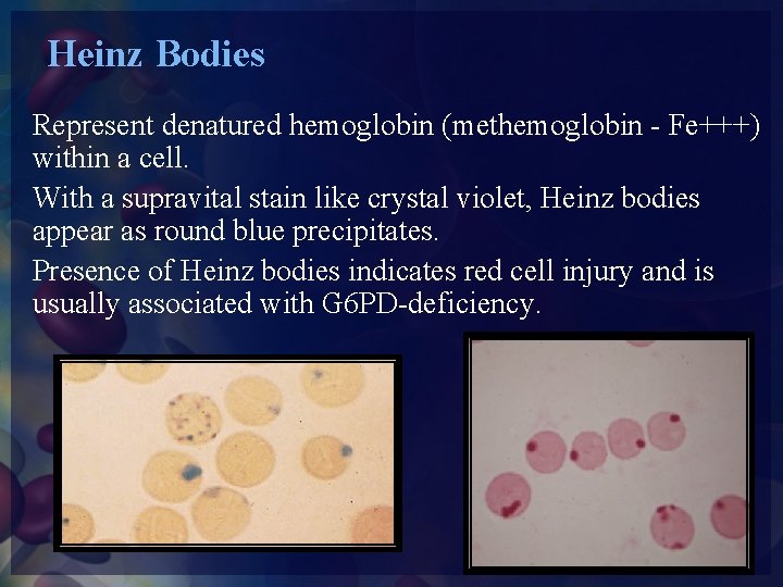 Heinz Bodies Represent denatured hemoglobin (methemoglobin - Fe+++) within a cell. With a supravital