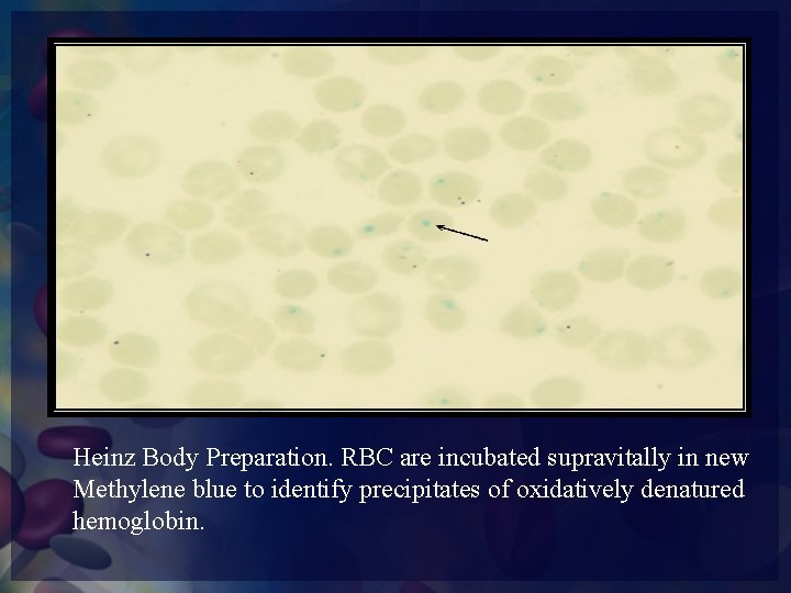 Heinz Body Preparation. RBC are incubated supravitally in new Methylene blue to identify precipitates