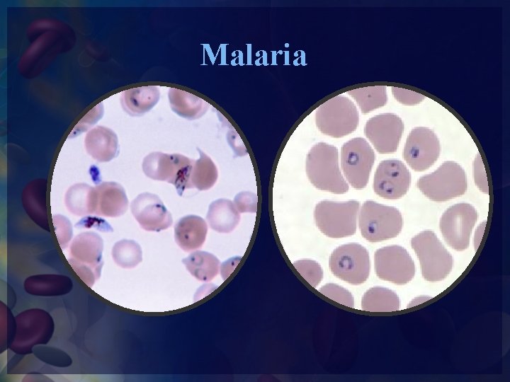 Malaria 