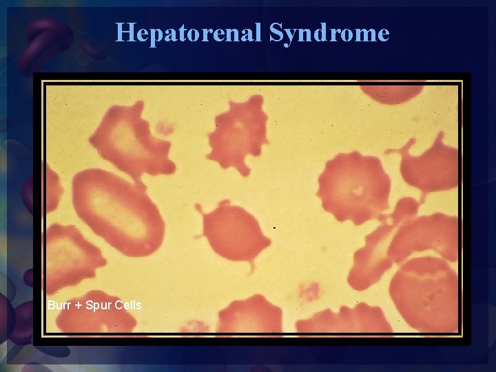 Hepatorenal Syndrome Burr + Spur Cells 