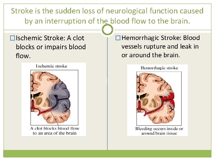 Stroke is the sudden loss of neurological function caused by an interruption of the