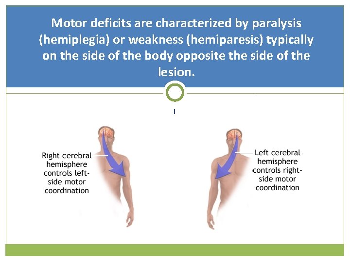 Motor deficits are characterized by paralysis (hemiplegia) or weakness (hemiparesis) typically on the side