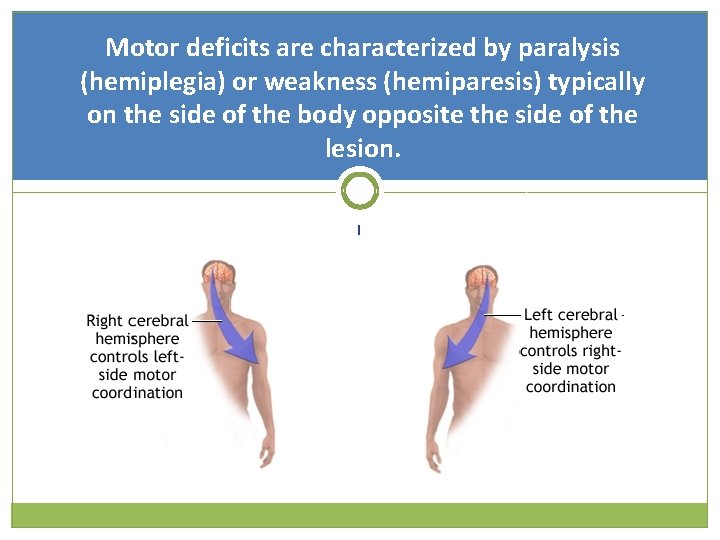 Motor deficits are characterized by paralysis (hemiplegia) or weakness (hemiparesis) typically on the side