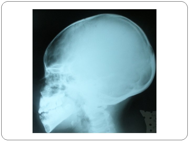 CHONDRODYSPLASIE METAPHYSAIRE TYPE SCHMID ETUDE DUNE OBSERVATION