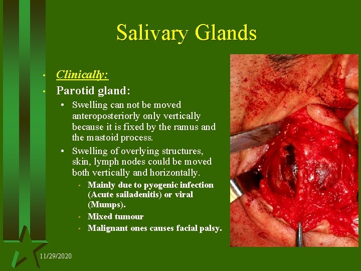 Salivary Glands • • Clinically: Parotid gland: • Swelling can not be moved anteroposteriorly