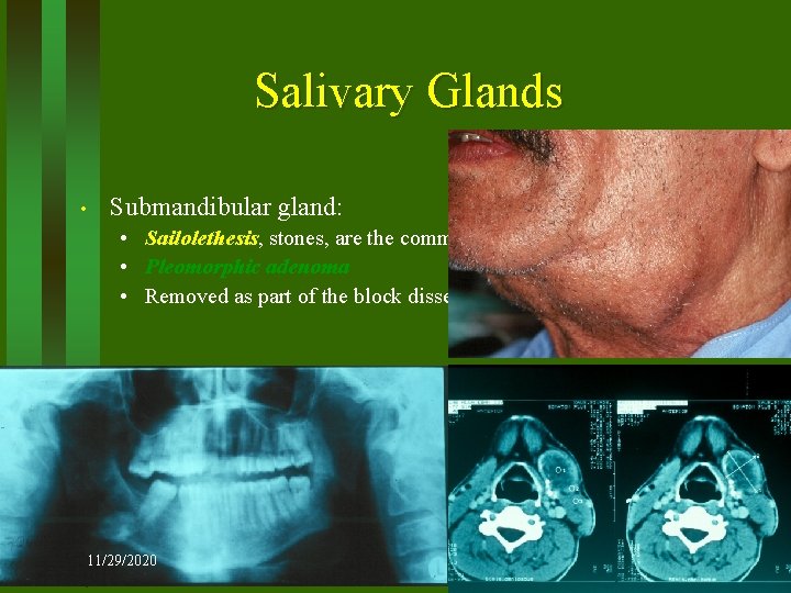 Salivary Glands • Submandibular gland: • Sailolethesis, stones, are the commonest cause of recurrent