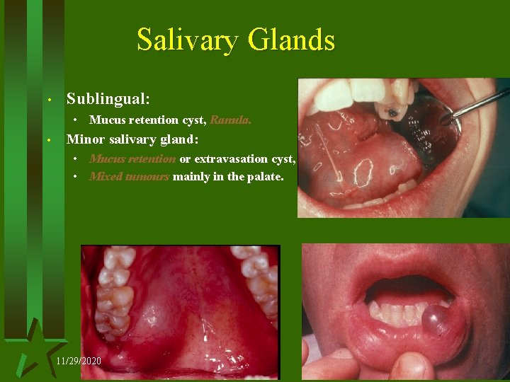 Salivary Glands • Sublingual: • Mucus retention cyst, Ranula. • Minor salivary gland: •