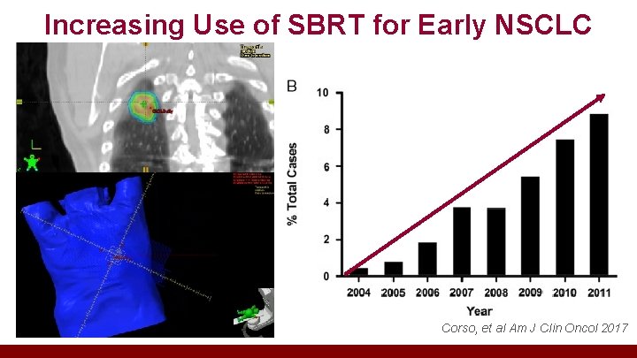 Increasing Use of SBRT for Early NSCLC Corso, et al Am J Clin Oncol