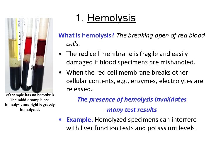1. Hemolysis Left sample has no hemolysis. The middle sample has hemolysis and right 1. Hemolysis Left sample has no hemolysis. The middle sample has hemolysis and right