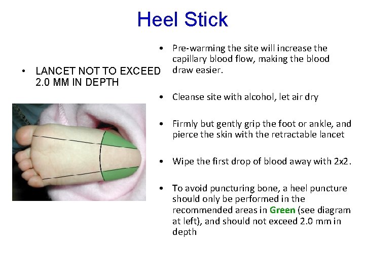 Heel Stick • Pre-warming the site will increase the capillary blood flow, making the Heel Stick • Pre-warming the site will increase the capillary blood flow, making the