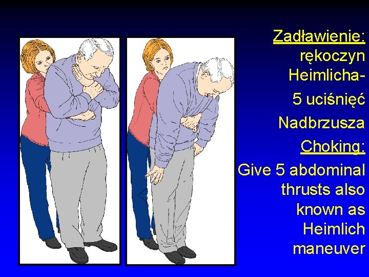 Zadławienie: rękoczyn Heimlicha 5 uciśnięć Nadbrzusza Choking: Give 5 abdominal thrusts also known as