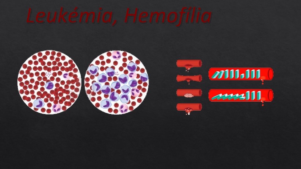 Leukémia, Hemofília 