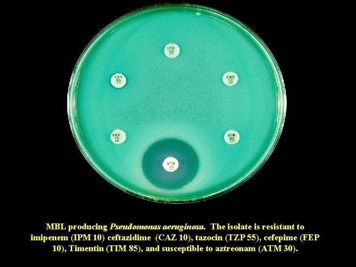 MBL producing Pseudomonas aeruginosa. The isolate is resistant to imipenem (IPM 10) ceftazidime (CAZ