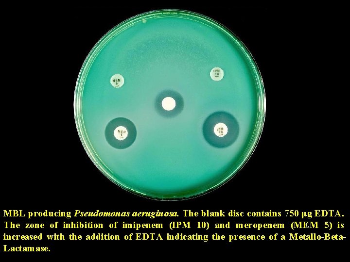 MBL producing Pseudomonas aeruginosa. The blank disc contains 750 μg EDTA. The zone of