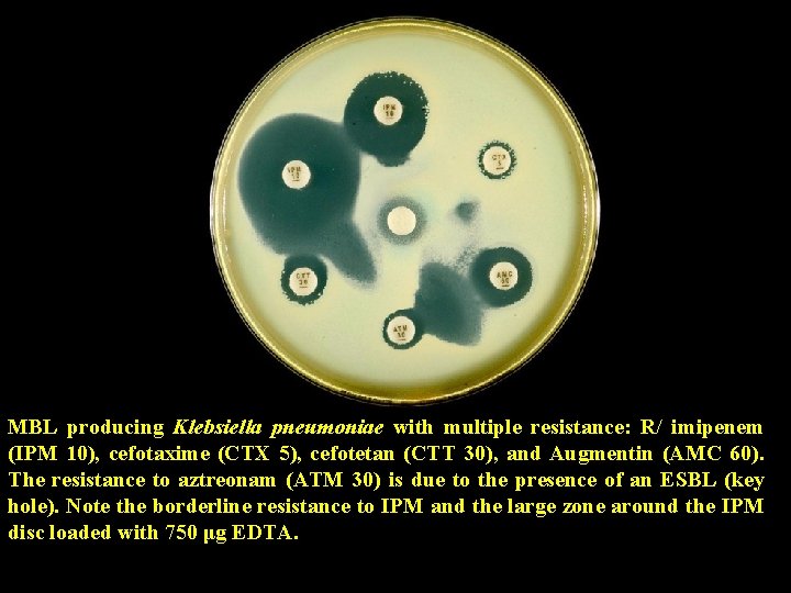 MBL producing Klebsiella pneumoniae with multiple resistance: R/ imipenem (IPM 10), cefotaxime (CTX 5),