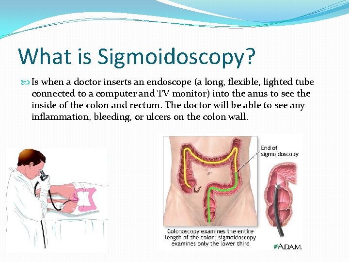 What is Sigmoidoscopy? Is when a doctor inserts an endoscope (a long, flexible, lighted