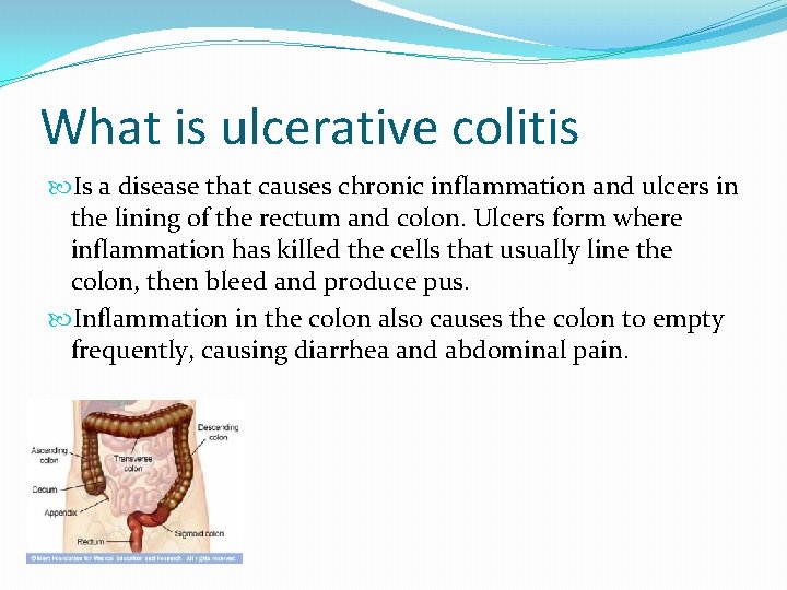 What is ulcerative colitis Is a disease that causes chronic inflammation and ulcers in