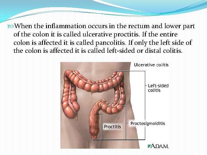  When the inflammation occurs in the rectum and lower part of the colon