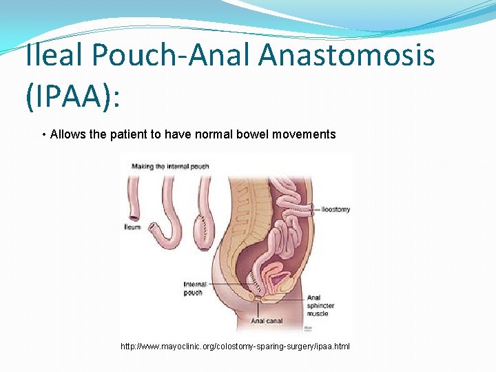 Ileal Pouch-Anal Anastomosis (IPAA): • Allows the patient to have normal bowel movements http: