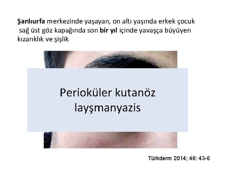 Şanlıurfa merkezinde yaşayan, on altı yaşında erkek çocuk sağ üst göz kapağında son bir