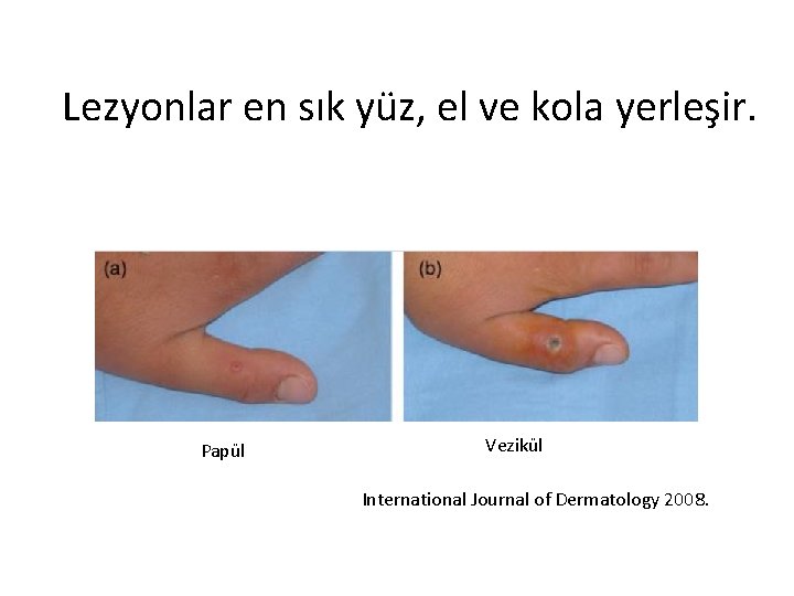Lezyonlar en sık yüz, el ve kola yerleşir. Papül Vezikül International Journal of Dermatology