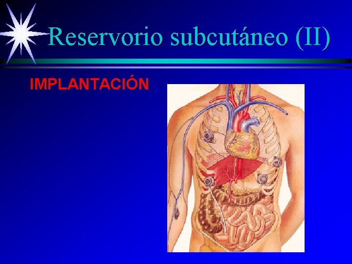 Reservorio subcutáneo (II) IMPLANTACIÓN 