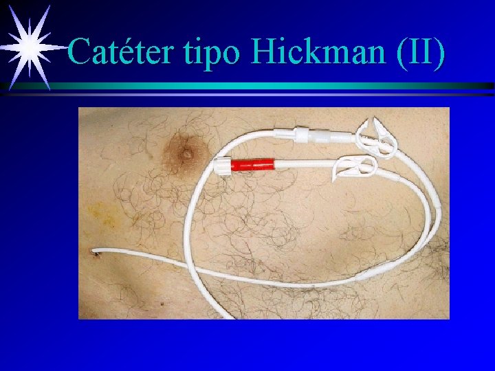 Catéter tipo Hickman (II) 