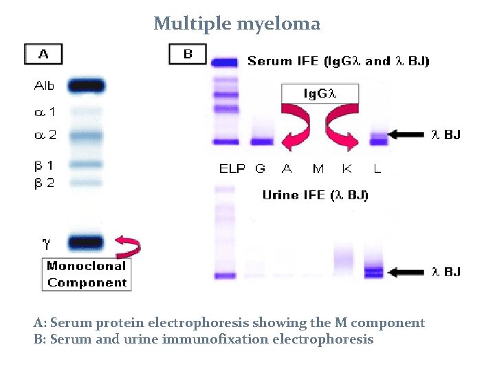 Multiple myeloma A: Serum protein electrophoresis showing the M component B: Serum and urine